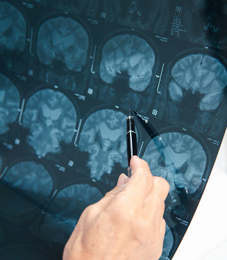 brain injuries